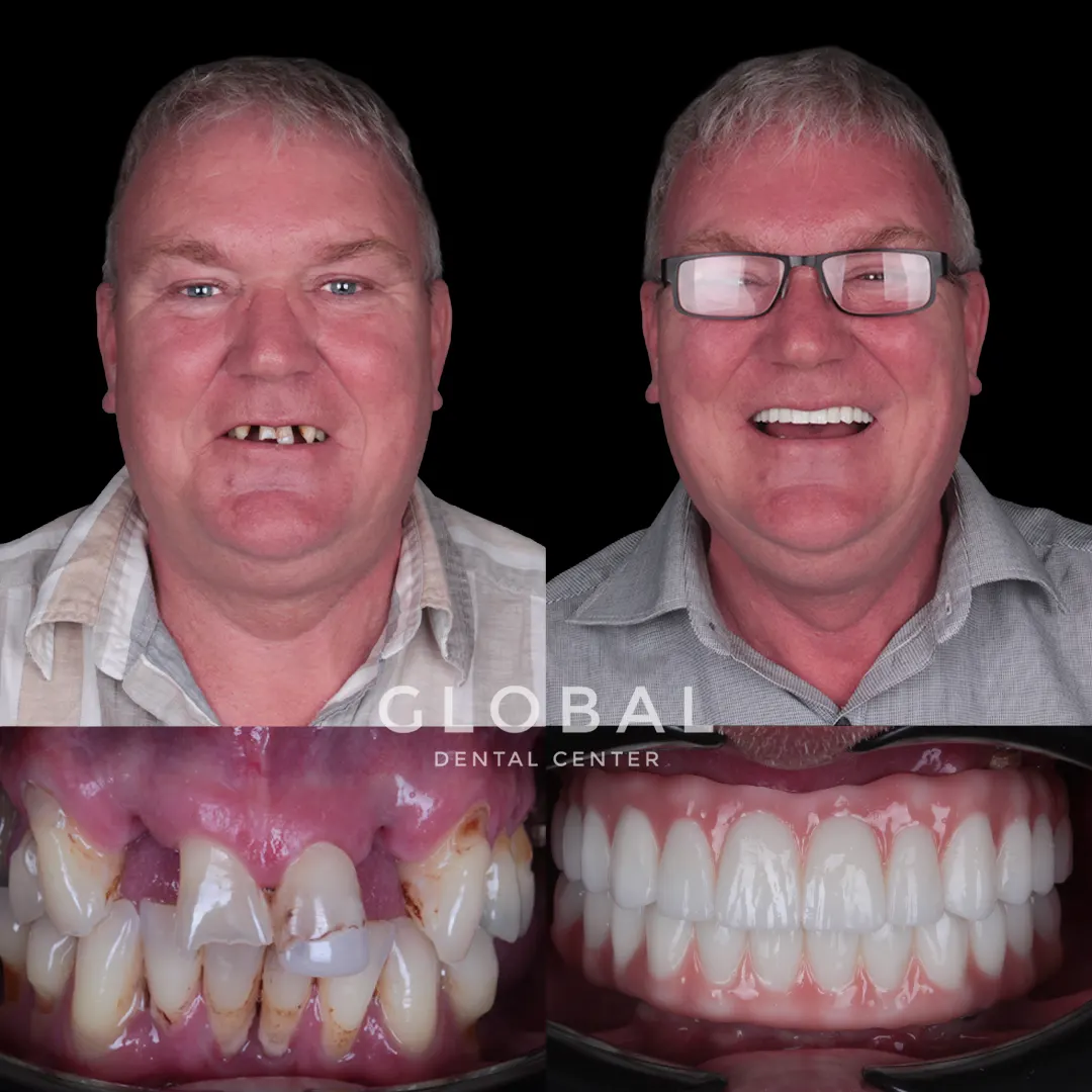 Dental Implants before and after result
