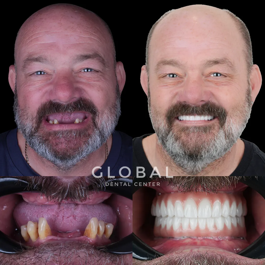 Dental Implants before and after result