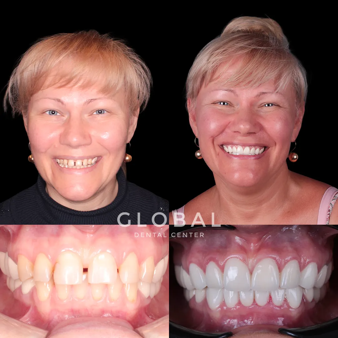 Laminate Veneer before and after result