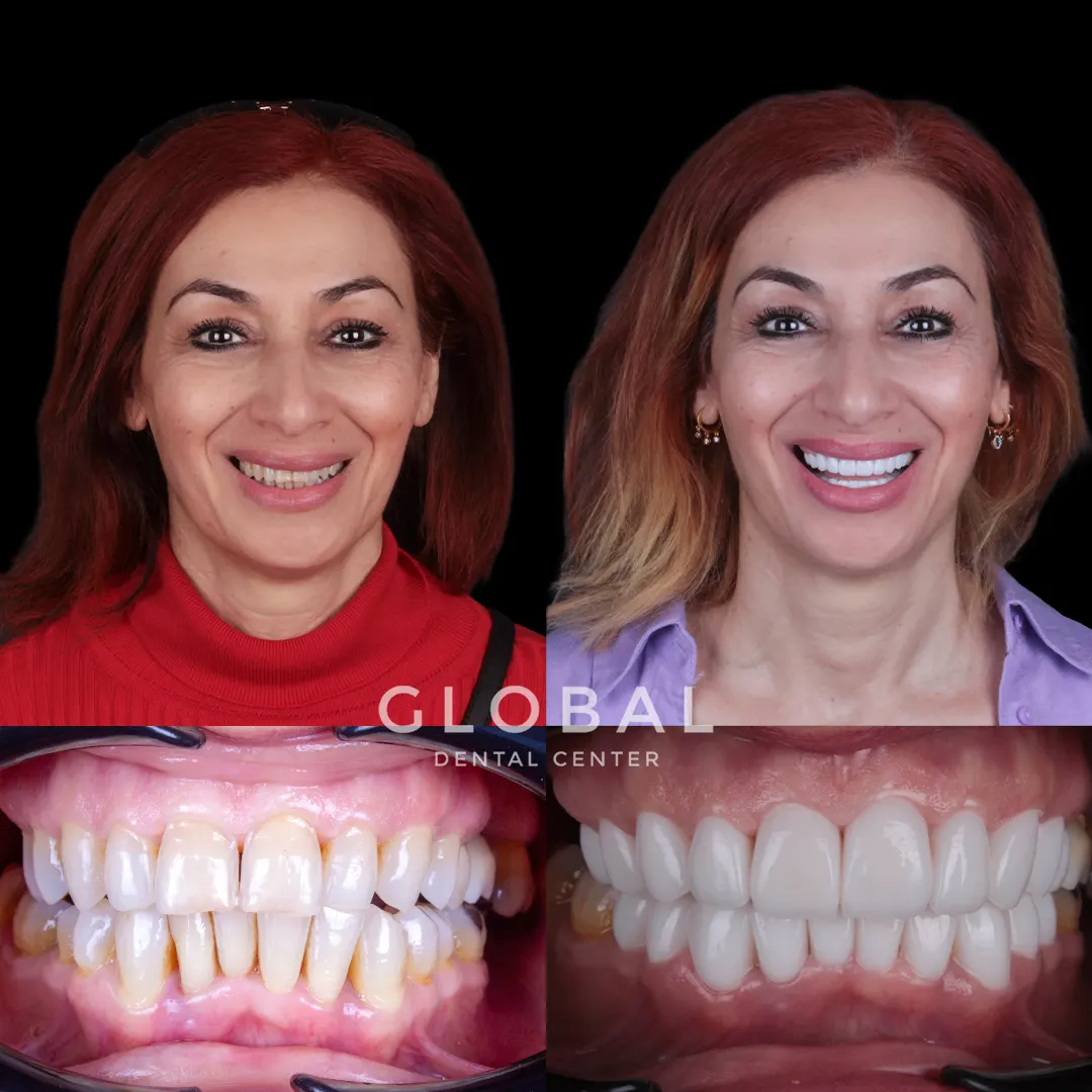 Laminate Veneer before and after result