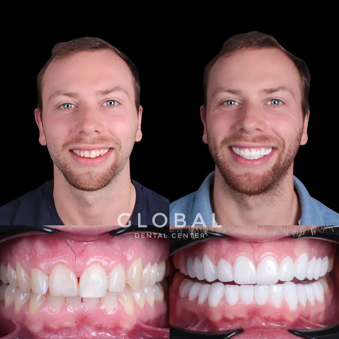 Laminate Veneer before and after result
