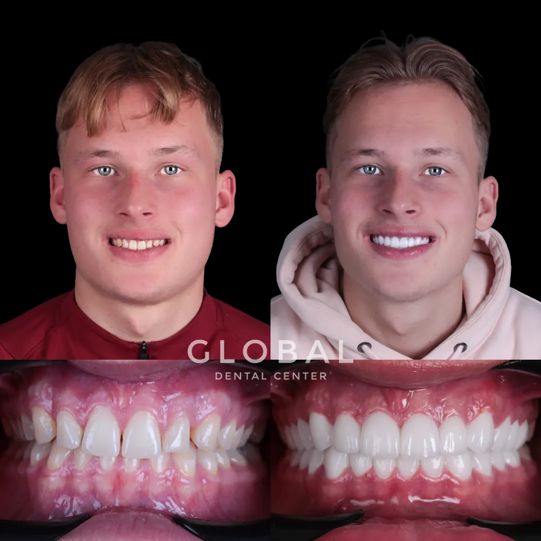 Laminate Veneer before and after result