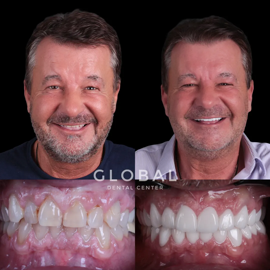 Laminate Veneer before and after result