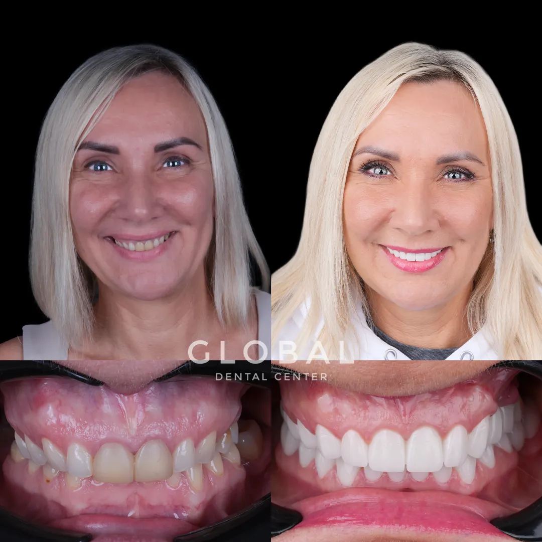 Zirconia Crowns before and after result