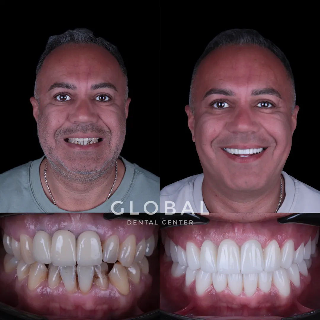 Zirconia Crowns before and after result