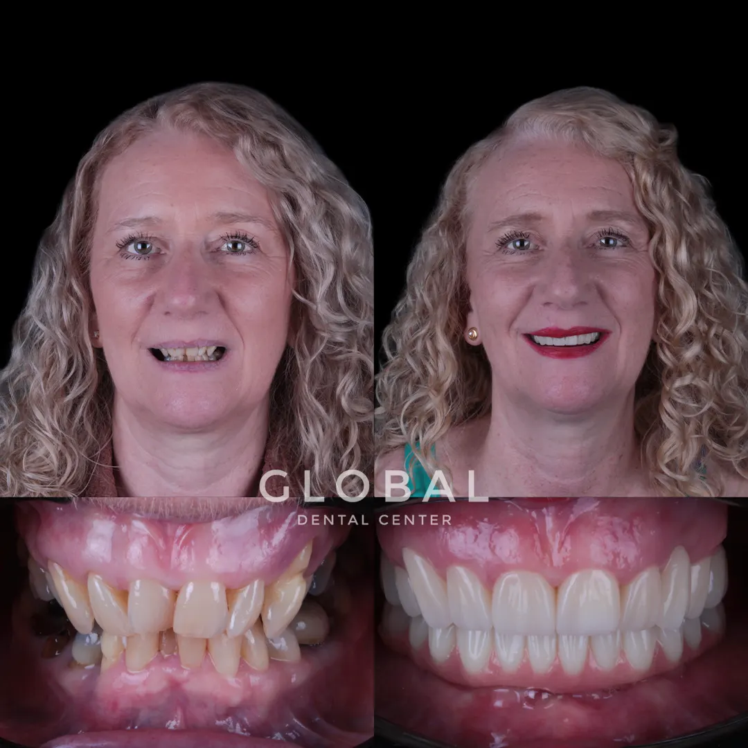 Zirconia Crowns before and after result