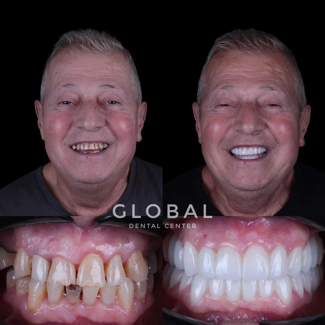 Zirconia Crowns before and after result