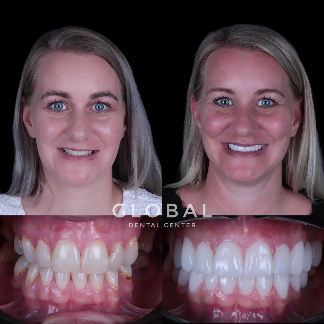 Zirconia Crowns before and after result