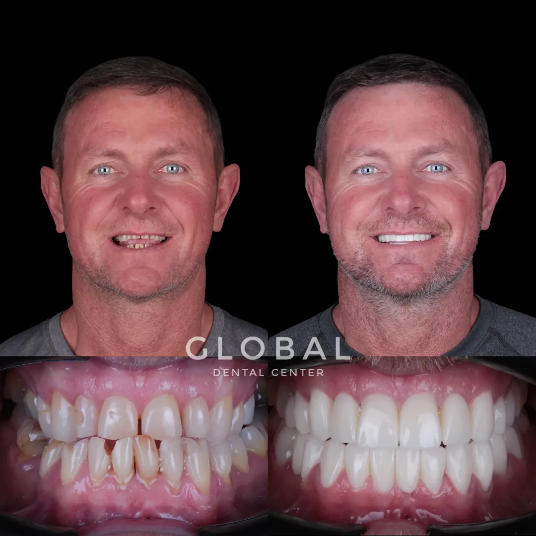 Zirconia Crowns before and after result