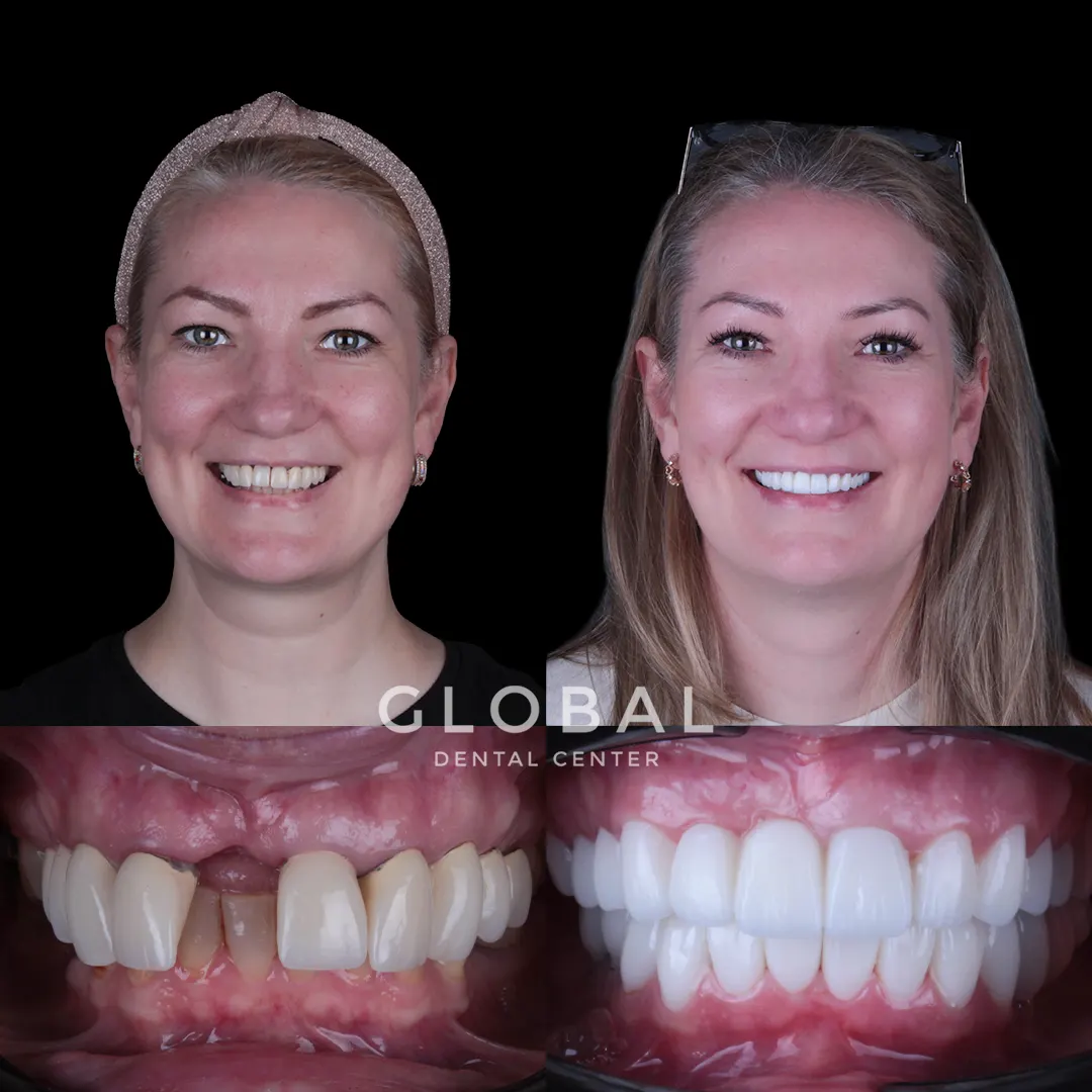 Zirconia Crowns before and after result