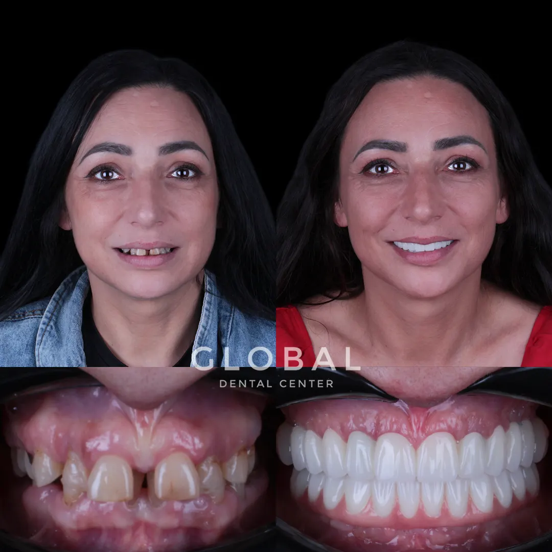 Zirconia Crowns before and after result