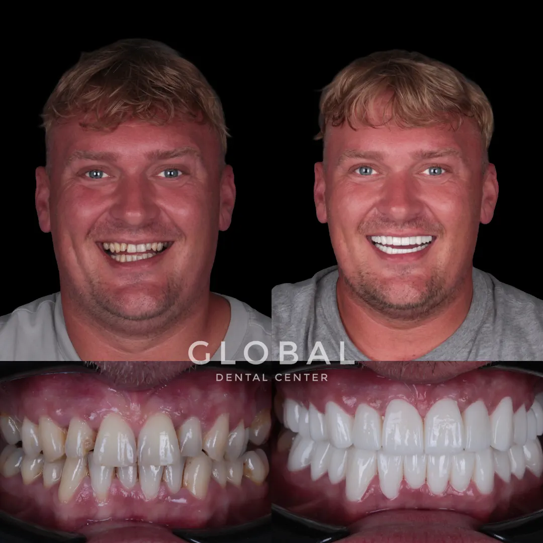 Zirconia Crowns before and after result
