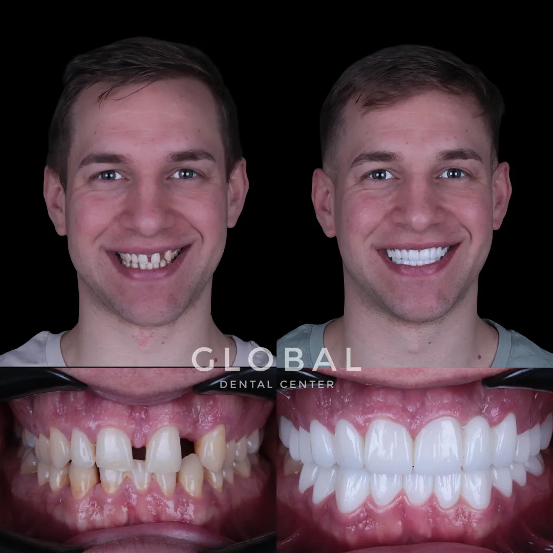 Zirconia Crowns before and after result
