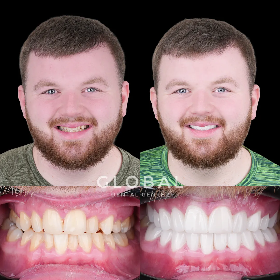 Zirconia Crowns before and after result