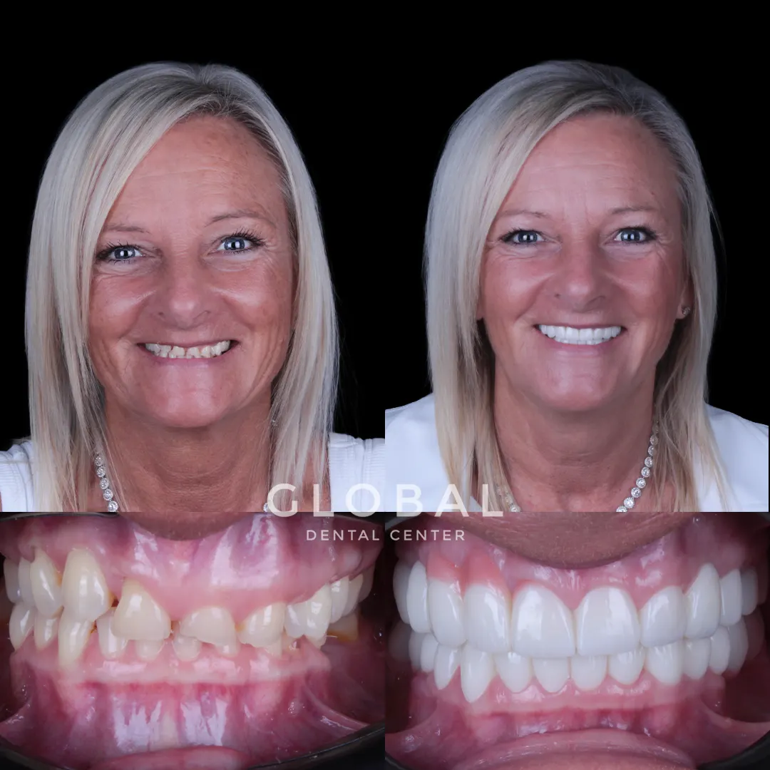 Zirconia Crowns before and after result
