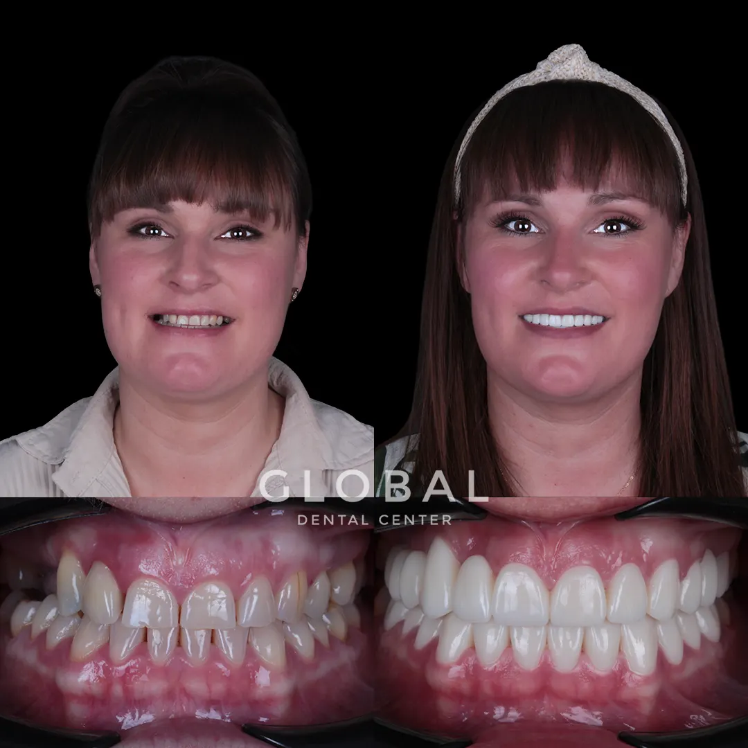 Zirconia Crowns before and after result