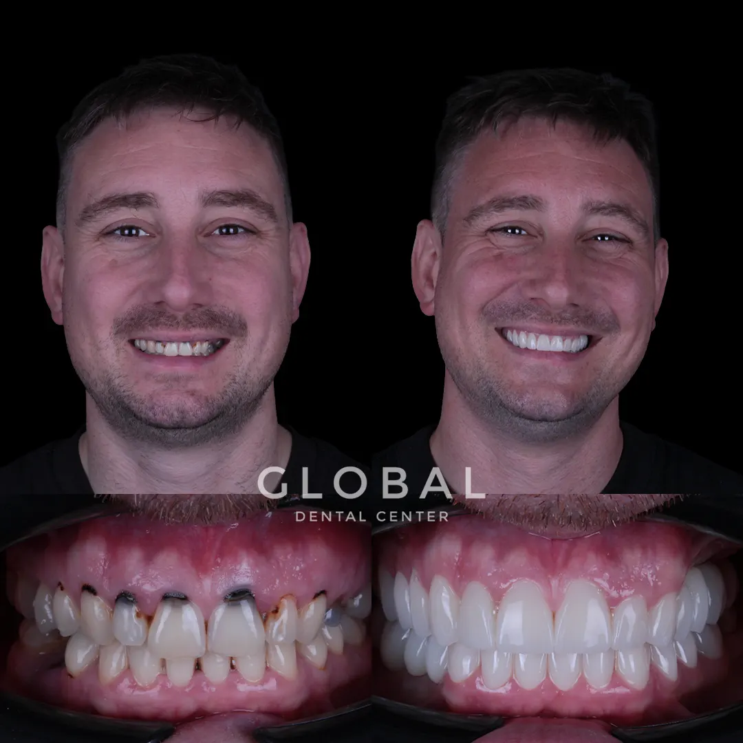 Zirconia Crowns before and after result