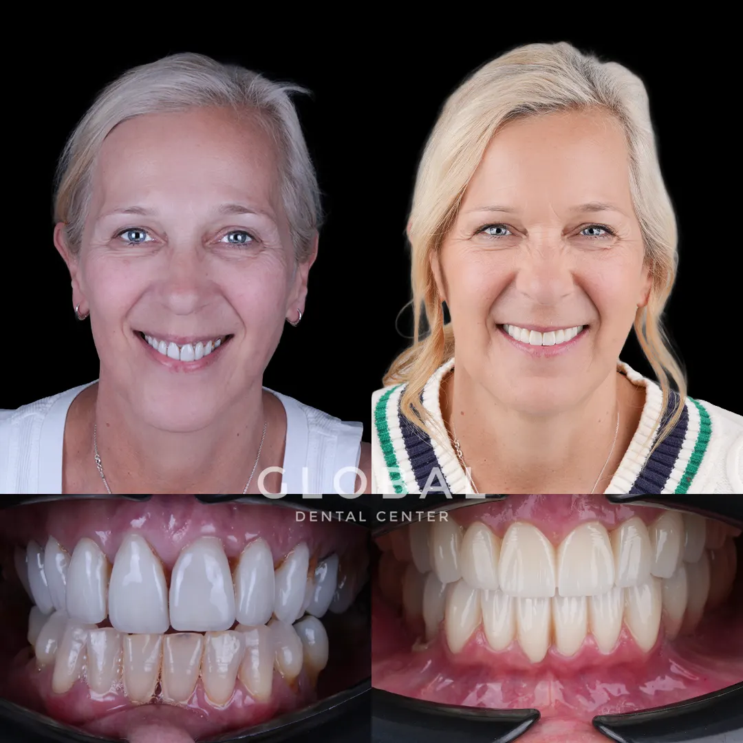 Zirconia Crowns before and after result