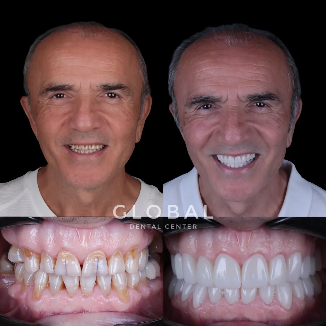 Zirconia Crowns before and after result