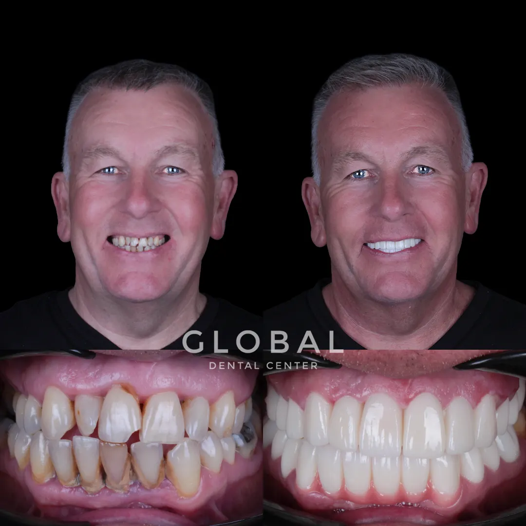 Zirconia Crowns before and after result