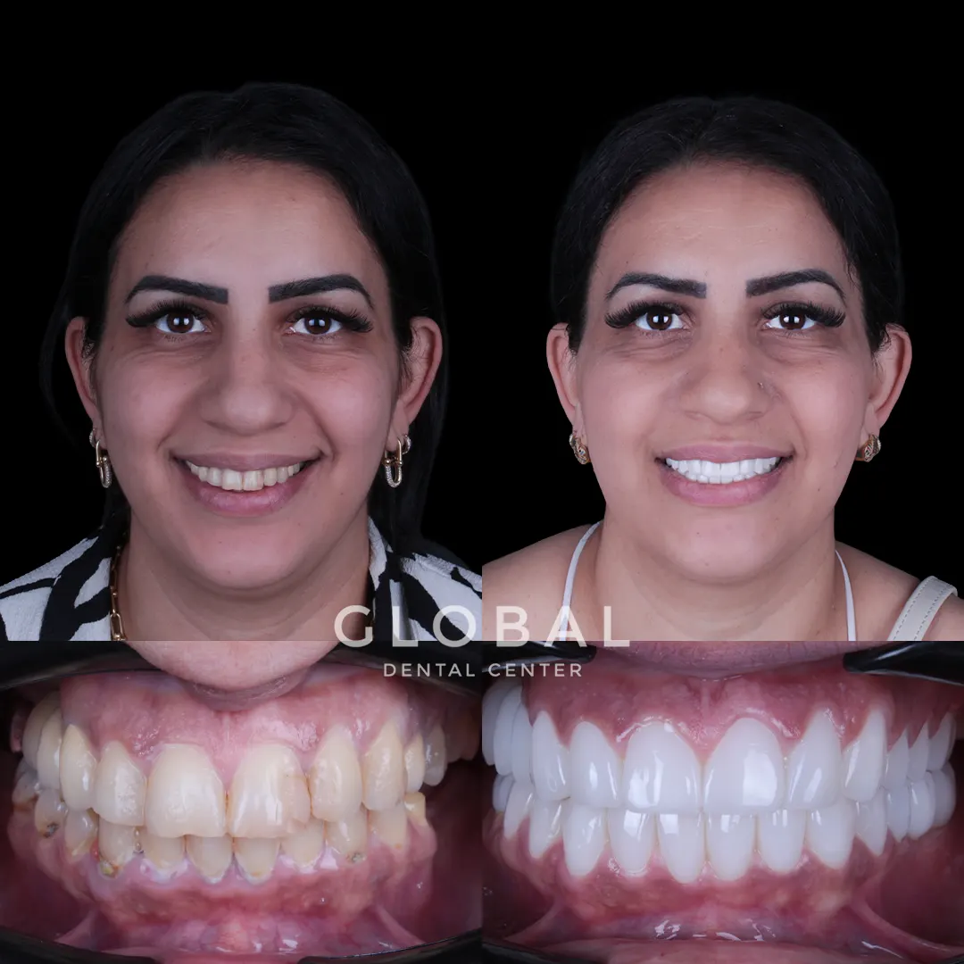 Zirconia Crowns before and after result