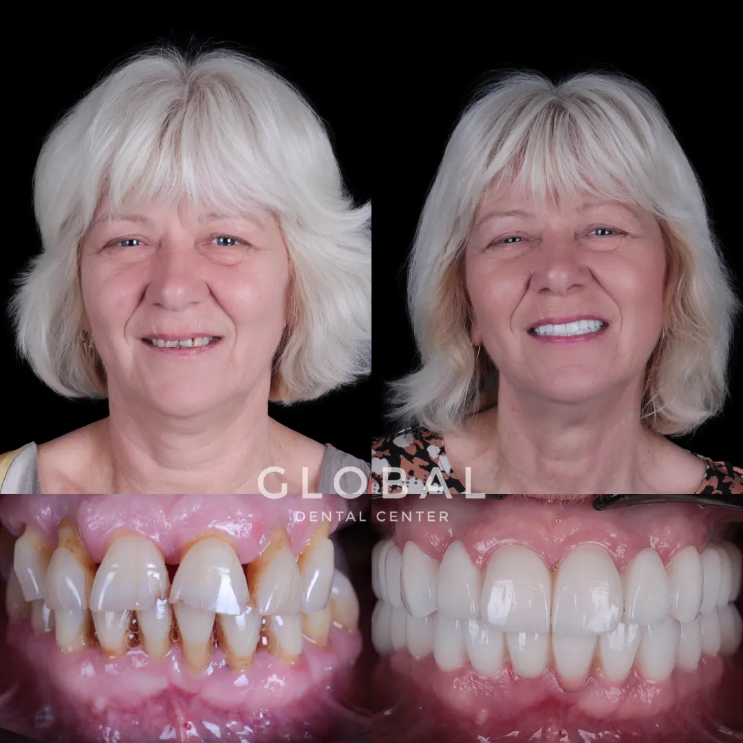 Zirconia Crowns before and after result