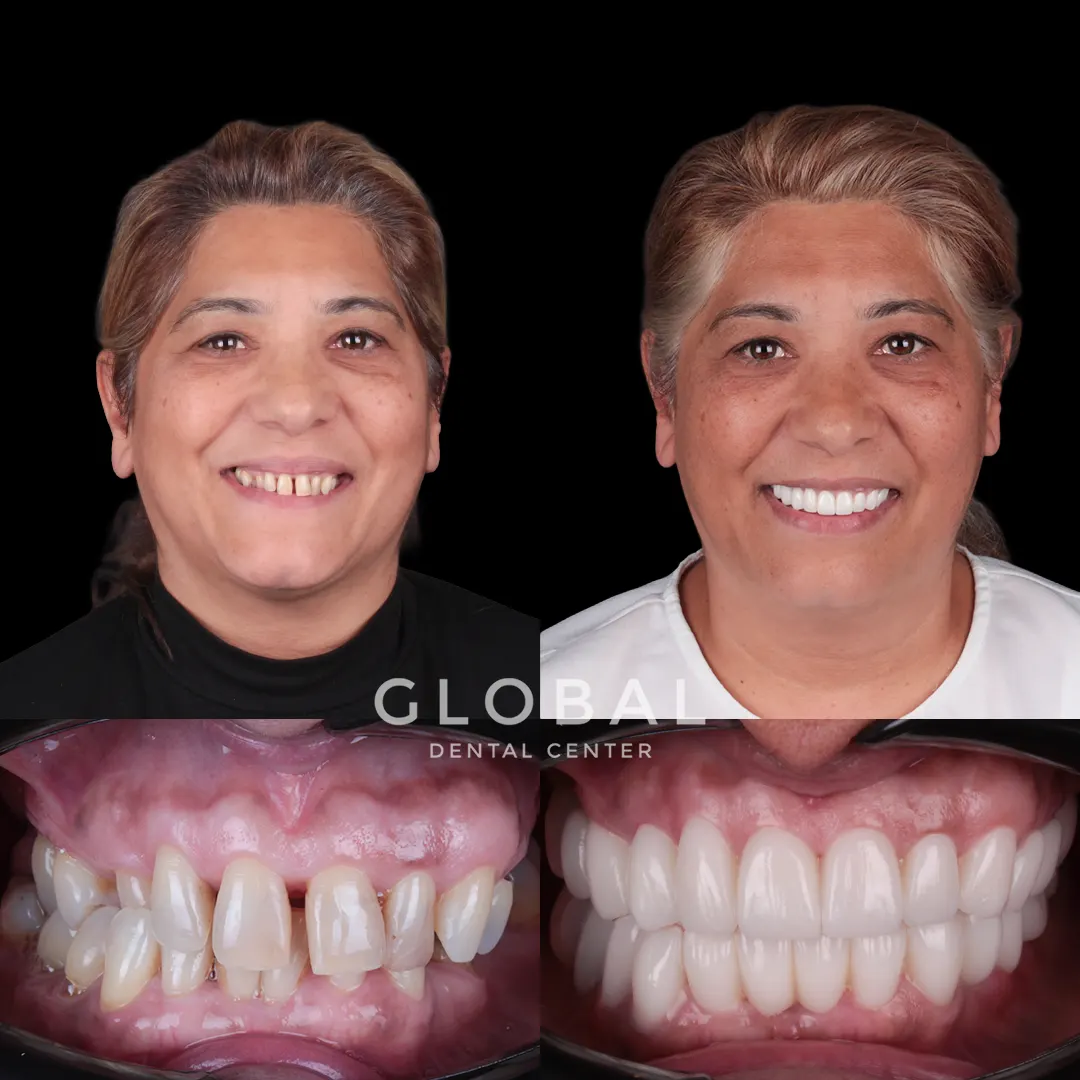 Zirconia Crowns before and after result
