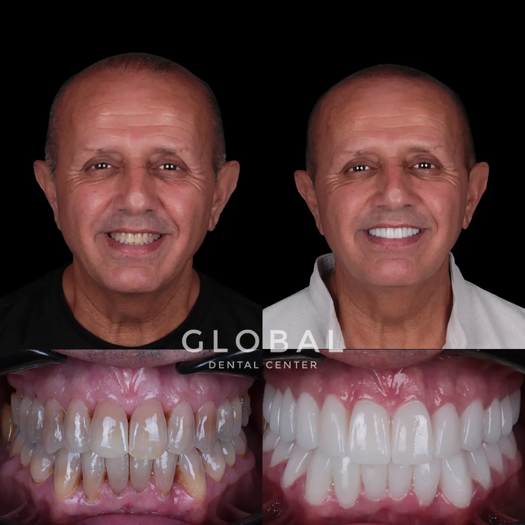 Zirconia Crowns before and after result