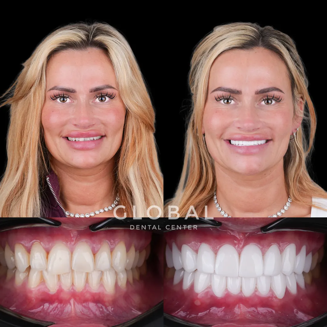 Zirconia Crowns before and after result