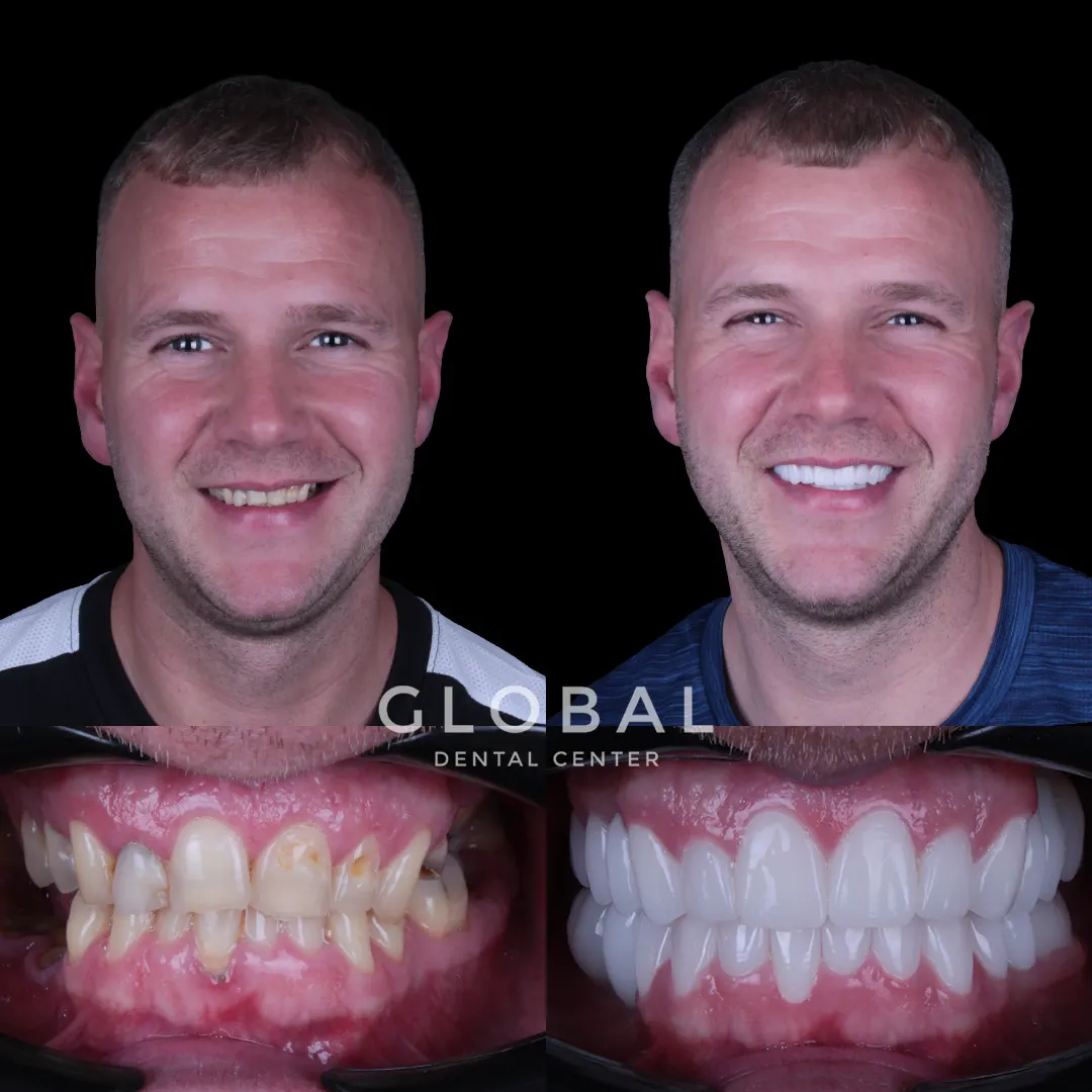 Zirconia Crowns before and after result